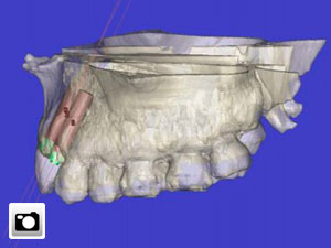 La tecnologa 3D aplicada a los implantes dentales