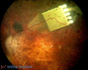 Implante binico pronto devolver la vista a ciegos